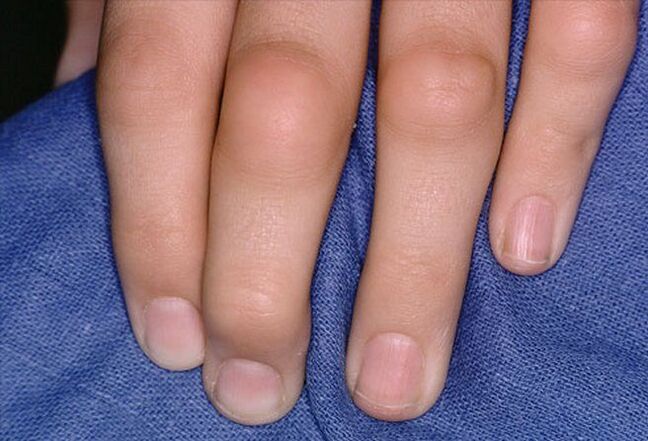 mast za liječenje artroze prsta