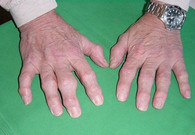 Osteoartritis prstiju