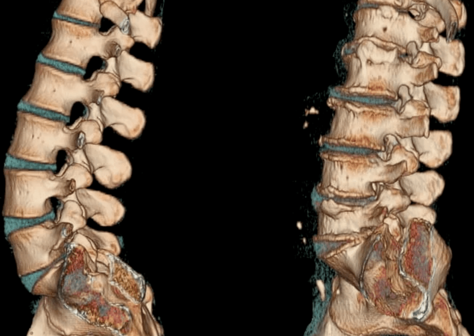 osteohondroza