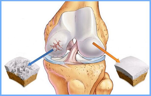 Normalni zglob koljena i zahvaćen artrozom
