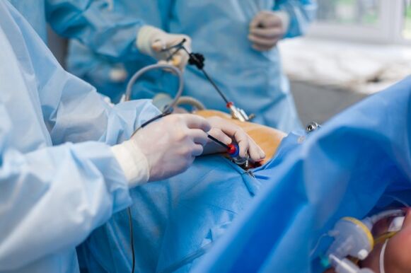 U uznapredovalom stadiju osteohondroze lumbalne kralježnice potrebna je operacija
