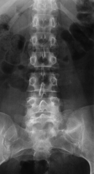 Za dijagnosticiranje lumbalne osteohondroze provodi se radiografija