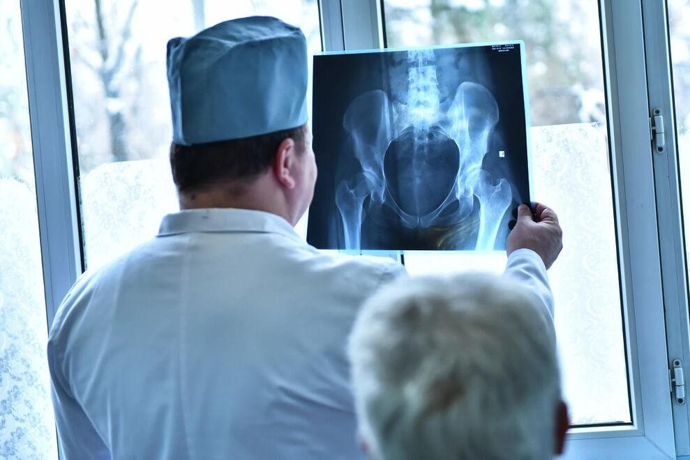 Liječnik gleda sliku zgloba kuka s artrozom