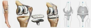 Arthroplasty na primjeru koljena